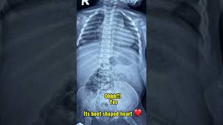 X ray of TOF #xray