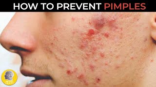 AMAZING TIPS TO PREVENT PIMPLES!!