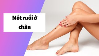 Xem bói nốt ruồi ở chân Trái, Phải Nam, Nữ có ý nghĩa gì? Có giàu không?