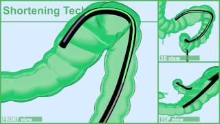 COLONSCOPY: Segment by Segment