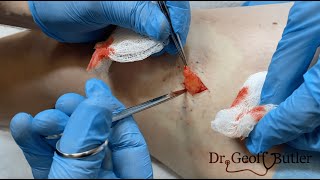 Leg Lipoma