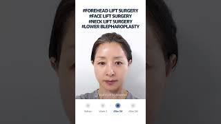 [B&A] Face&Neck Lift, Endoscopic Brow Lift, Lower Blepharoplasty in Korea Plastic Surgery #shorts