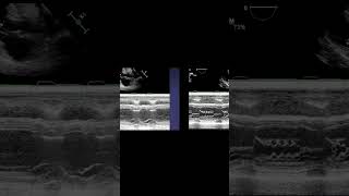 AF seen on all chambers and flows! #echocardiography #AF #chamber #prime #diagnosis