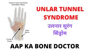 ULNAR TUNNEL SYNDROME- EPISODE 28