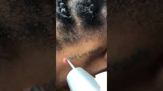 Laser tattoo removal, removing behind the ear tattoo