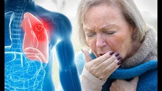 Lung cancer symptoms Persistent cough could be a sign of the condition