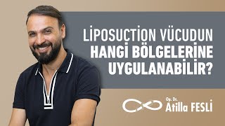 Liposuction Vücudun Hangi Bölgelerine Uygulanabilir?