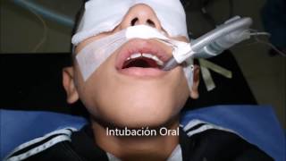 Quiste Dentigero. Tumores de los Maxilares