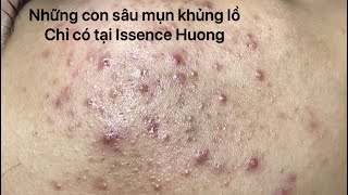 Seri nặn mụn-Part 40 Sâu mụn nảy mầm