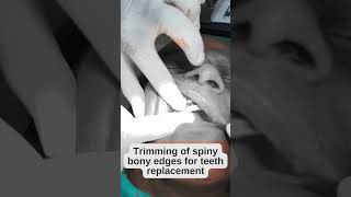 How Alveoloplasty Procedure is Done || Reshaping The Gum Tissue || #shorts