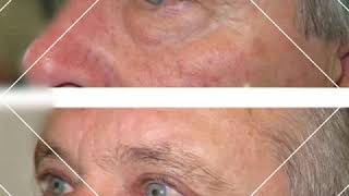 Blefaroplastia