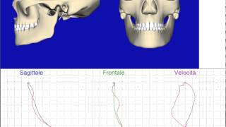 Analisi del movimento mandibolare con bite ortotico neuromuscolare