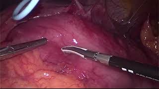 Laparoscopic debriedment for acute pancreatitits/Kəskin pankreatitəə görə laparoskopik debriedment