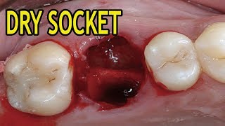 Dry Socket Pictures - Dry Socket or Alveolar Osteitis Images