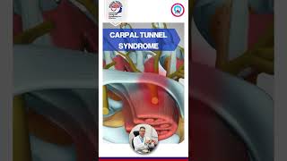 Carpal Tunnel Syndrome in Winters | Dr. Ashish Yadav | Physiotherapist | Brain Tower Hospital