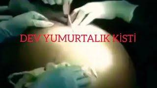 DEV YUMURTALIK KİSTİ AMELİYATI