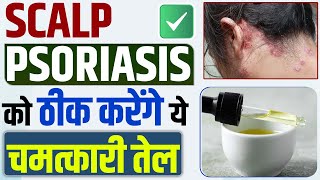 Oils for scalp health | स्कैल्प सोरायसिस को ठीक करेंगे ये चमत्कारी तेल | Best Oil for scalp