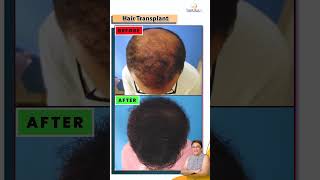 Is Hair Loss Impacting Your Lifestyle? | Understanding the Effects & Solutions