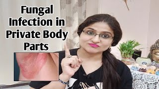 How To Treat Fungal Infection Of Private Body Parts at Home | Fungal Infection के लिए Home Remedy |