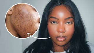 2022 FULL COVERAGE ROUTINE FOR ACNE SCARS AND HYPERPIGMENTATION