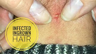 Ingrown hair got infected