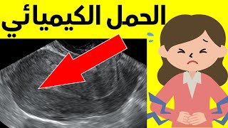 ما هو الحمل الكيميائي | اعراض الحمل الكيميائي | كيف يظهر الحمل الكيميائي في السونار دكتور يوسف عيد