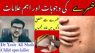 Causes And Main Symptoms Of Measles | khasra Ka Ilaj | khasra Ki Alamat | Measles