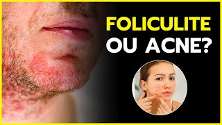 FOLICULITE OU ACNE [APRENDA A DIFERENCIAR E TRATAR]