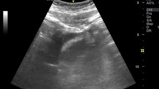 Small pericardial effusion in case of recurrence of malignant teratoma of ovary