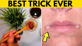 how to get rid of angular cheilitis fast in cracked corner of mouth and lips