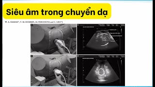 Siêu âm trong chuyển dạ - BS. Trần Nhật Thăng