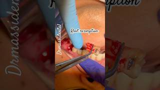 Wisdom tooth extraction