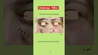 Under-eye filler