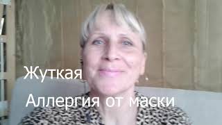 АЛЛЕРГИЯ жуткая, от Корейской маски/ЛЕЧЕНИЕ /Осторожно с косметикой! #АллергияЛечение, #Аллергия