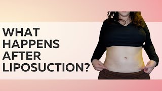 The Tea On Liposuction [Recovery, Drainage, Scars]