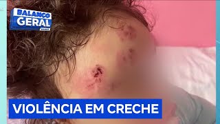 Mãe denuncia creche de SP após encontrar filha de 1 com hematomas no rosto