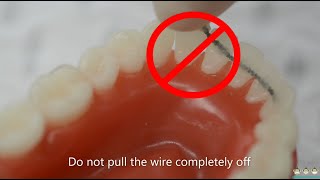 What to do with broken fixed wire retainer | Evolution Orthodontics