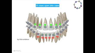 Class III open bite TADs biomechanics with torque selection - Биомеханика коррекции 3 класса