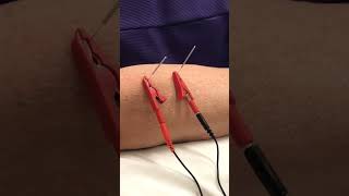 Dry Needle Electrodes in Arm | Shorts | Stuff Lab #shorts