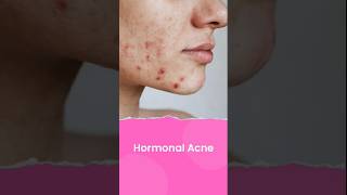 Hormonal Acne: How to Identify and Treat It Effectively! #Shorts