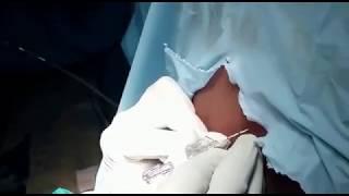 Para vertebral block anaesthesia at T 10, 11,12 L1 for inguinal hernia surgery