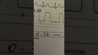 Reading Tele Strip with Caliper #Nursing #Telemetry