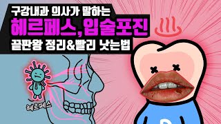 입술포진 헤르페스 단순포진 원인과 빨리 낫는 법, 구강내과 의사가 알려주는 증상과 약까지