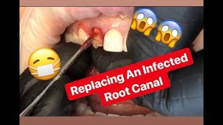 Replace Your Root Canal wIth a Non-Metal Dental Implant