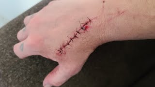 10 stitches from falling on my toilet