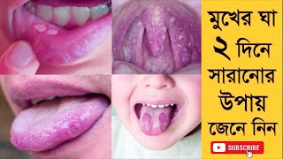 Oral thrush, Denture stomatitis,Fungal infections of the mouth,Tinea pedis, Tinea versicolor