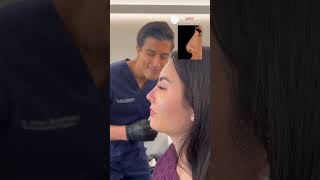 Cast removal after Closed Scarless Rhinoplasty | Dr. med. Simon Zimmermann