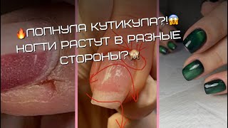 Лопнула кутикула?!😱Ногти растут в разные стороны?🙈