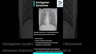 Kartagener syndrome