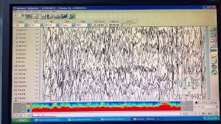 EEG of Non Convulsive Status Epilepticus Patient 🧠 #eeg #epilepsy  #neurology